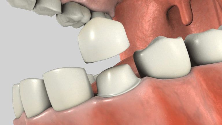 Full Porcelain Crowns